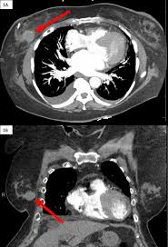 Do you believe your eating habits to be healthy? Cureus Hematoma Mimicking Breast Cancer On Ct Scan And Breast Ultrasound