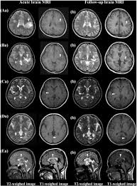 Image result for Brain Lesion