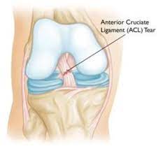 3d acl surgery animation created by immersion media. Acl Injury Does It Require Surgery Orthoinfo Aaos