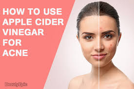 Can You Cure Your Acne With Apple Cider Vinegar