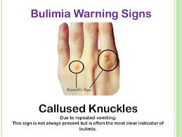 Bulimia is characterized by bingeing, or eating unusually large amounts of food in a single episode, and purging. Bulimia Warning Signs