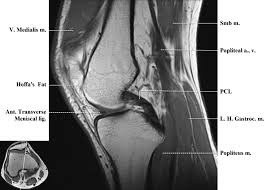 In the two most recent series, meniscus mri and mri of the supporting structures, we focus on two knee mri anatomy & diganoses covered in this course. Http Www Smartview Co Wp Content Uploads 2014 02 Imagen Mr Normal Anatomia Rodilla Pdf