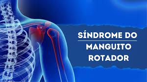 Síndrome do Manguito Rotador (M75.1) é Doença do Trabalho? - PericialMed