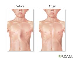 Image result for Pectus Excavatum