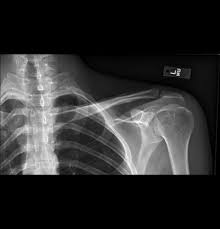 Additional imaging of the lung apices • properly positioned (not rotated or angulated): Companion Shadow Wikipedia