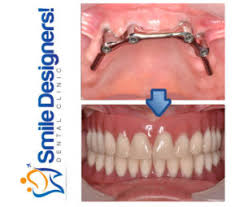 Un dentier tient en place dans la bouche par l'effet de ventouse créé par la salive qui s'accumule entre. Prothese Sans Palais
