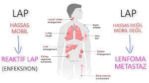 Lenf kanseri olark bilinen tıbbi adı lenfoma olan bu hastalık en sık genç erişkinlerde ortaya çıkıyor, çocukluk çağında 12. Lenfomalar Hodgkin Non Hodgkin Youtube