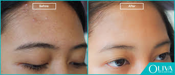 Expert advice, special offers & savings. Small Pimples On Forehead Causes Treatments And Results