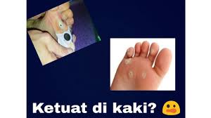 Di mana saja ketuat boleh tumbuh.? Tutorial Cara Menghilangkan Ketuat Di Kaki Youtube