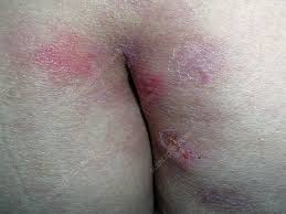Image result for genital herpes