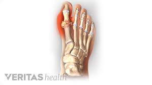 Image result for gout