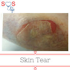 Image result for Skin Tear
