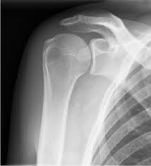 Upper extremity emergency medicine by matthew wong. X Schouder Startradiology