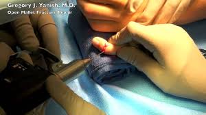For simple closed mallet ﬁnger injuries, surgery is controversial. Open Mallet Fracture Repair Youtube