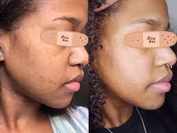 My Pih Is Finally Clearing Up Beforeafter Rskincareaddiction