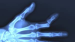 Continue elevating your finger when possible. Finger Dislocation Summit Orthopedics Condition Guide