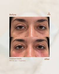 PRF EZ Gel has been keeping us busy lately, and we're in love with the  gorgeous results🔥 EZ Gel is giving our patients their own real-life  Instagram filter, smoothing and brightening under