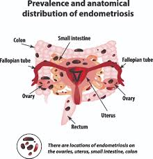 Stage iv endometriosis is the most severe stage of endometriosis and as a result, the patient feels the following symptoms: Iunderstandendometriosis