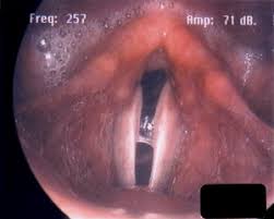 Image result for Chronic Laryngitis