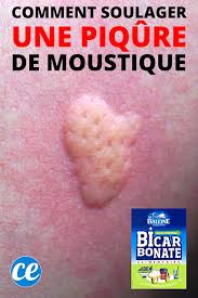 Appliquer un glaçon sur la piqûre de moustique soulage instantanément. Comment Soulager Une Piqure De Moustique Avec Du Bicarbonate En 1 Min