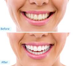 Teeth whitening will not produce paper white teeth like seen in the movies this is a result of having the surface of the teeth replaced with porcelain veneers. Why Do My Teeth Hurt After Whitening Lane And Associates Dentistry