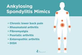 Ankylosing Spondylitis Misdiagnosis Diseases As Can Be Mistaken For