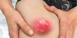 Sedang mencari obat penghilang bisul yang terbukti ampuh khasiatnya dalam menyembuhkan dan bagi anda yang saat ini sedang mencari cara menghilangkan bisul di kepala ( wajah, jidat. Jenis Bisul Tanpa Mata Bolehkah Dicungkil Bagi Hilangkan Nanah
