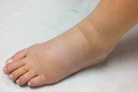 Tendangan ini mengarah ke depan yang sifatnya mendorong ke sasaran dada dengan perkenaan. Mengenal Penyakit Kaki Gajah Gejala Dan Pencegahannya Lifepack Id