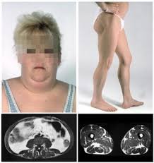 Image result for Lipodystrophy