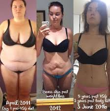 Pin On Gastric Sleeve