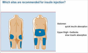 We did not find results for: Bath Wiltshire And North Somerset Diabetes Service Injection Sites