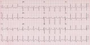 Brugada Syndrome Litfl Ecg Library Diagnosis