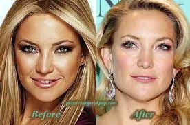 We did not find results for: Kate Hudson Plastic Surgery Boob Job Nose Job Before After Pictures