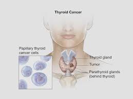 .of ioduria, thyroid gland ultrasound, and assessment of thyroid status; About Thyroid Cancer Facts Types Symptoms Osuccc James