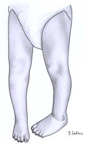 Image result for In-Toeing