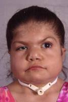 CHARGE 101: Diagnosis, Features, and the Importance of Sensory Deficits