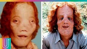 La misteriosa historia de Roy Lee Dennis y su rara enfermedad ósea