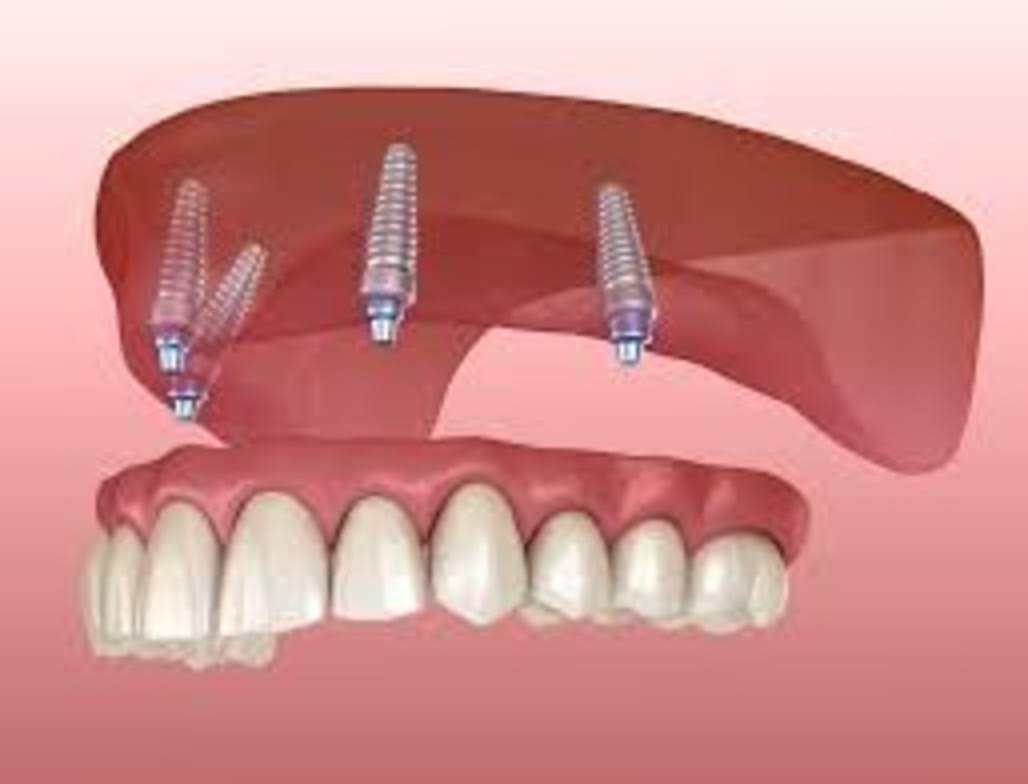 Fixed Dentures product image