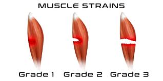 This can happen if you overwork the muscle or twist it too hard. Facebook