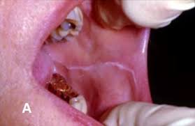 Oral cancer screening can't detect all mouth cancers. Premalignant Oral Lesions