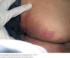 Hsv spreads through direct contact. Herpes Simplex Basicmedical Key