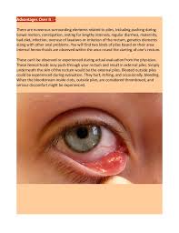 Maybe you would like to learn more about one of these? How To Define How Long Do Hemorrhoids Last