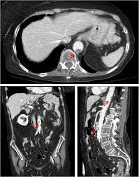We did not find results for: Mural Thrombus Diagnosis And Treatment Options