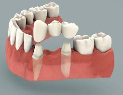 This procedure may take over 2 weeks. Dental Bridge Procedure Dental Bridge Vs Dental Implant