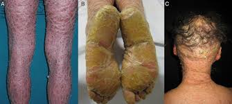 Image result for Ichthyosis