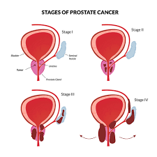 Metastatic prostate cancer symptoms vary greatly depending on the level of the disease, sidana says. Prostate Cancer Medicentres
