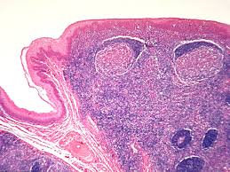 Inflammation of lingual tonsils at the root of the tongue symptoms: Medpics Uc San Diego School Of Medicine