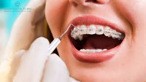 Carefully clean around wires and pins. How To Take Care Of Your Teeth Before And After Braces Lasry Dental Clinic