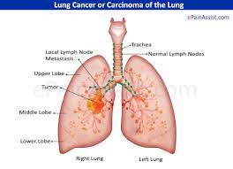 Misdiagnosis also raises the specter of community outbreak. Lung Cancer Treatment Causes Symptoms Risk Factors Stages