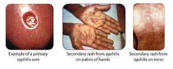 Clap - Gonorrhea (Neisseria Gonorrhoeae)